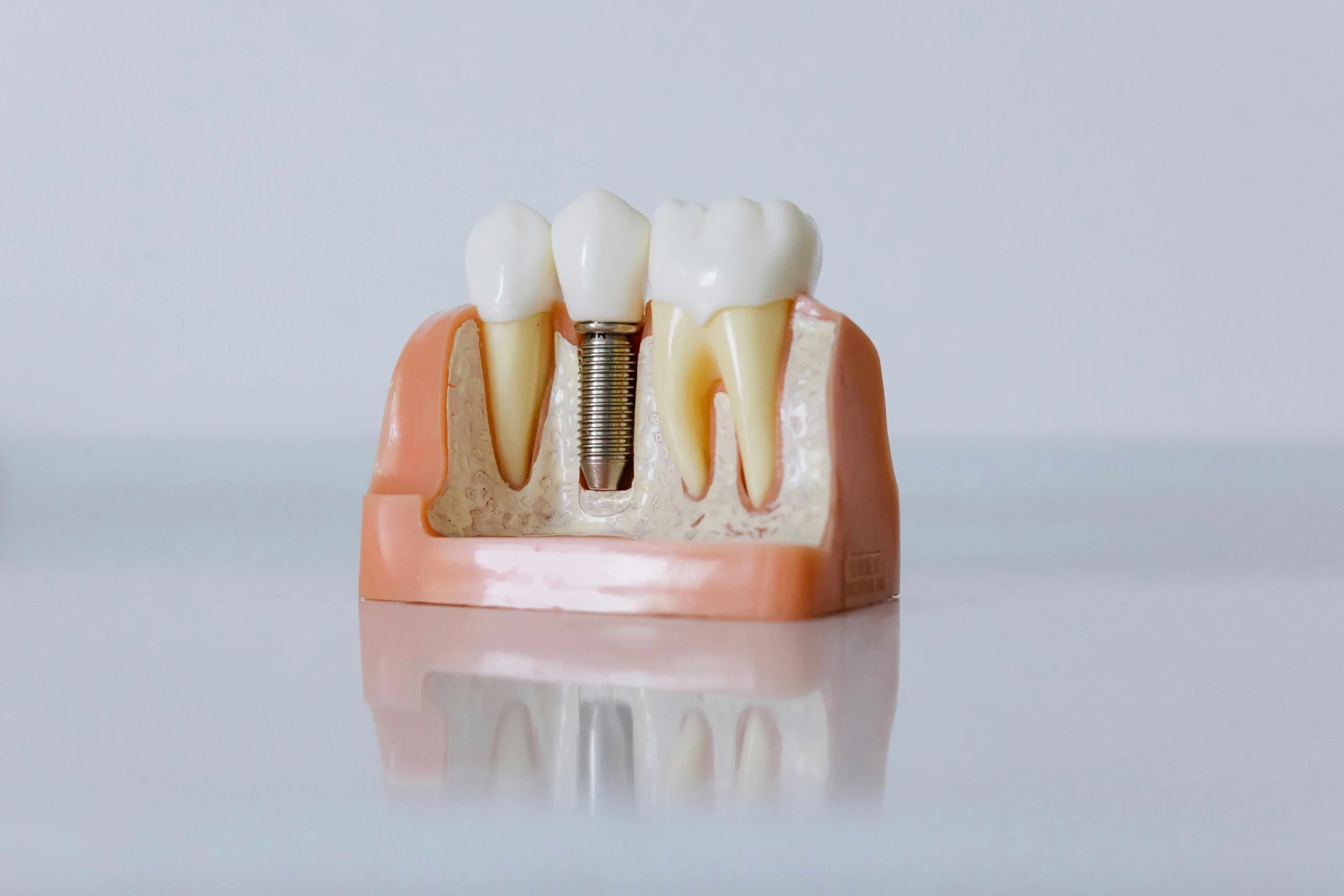Dental Implants Dubai Pearl Dental Clinics